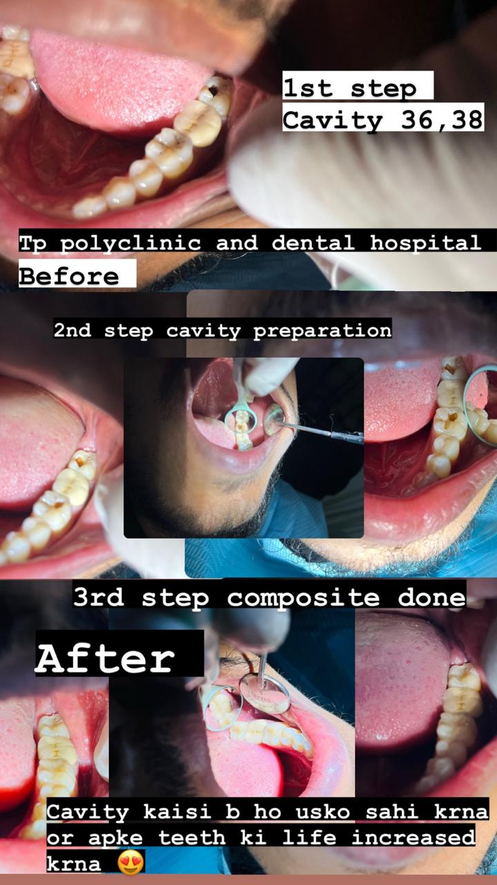 Before and after cavity composite treatment